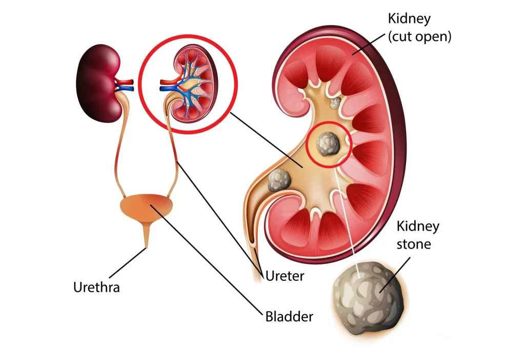 Kidney stone and urinary tract care illustration for urology treatment in Birmingham